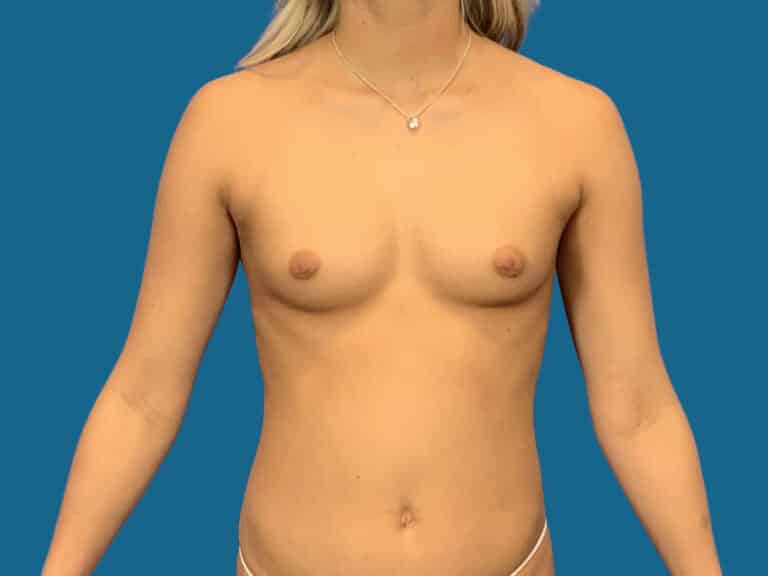 Before Image:  - front