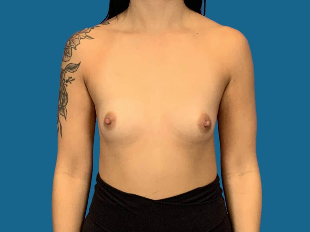 Before Image:  - front