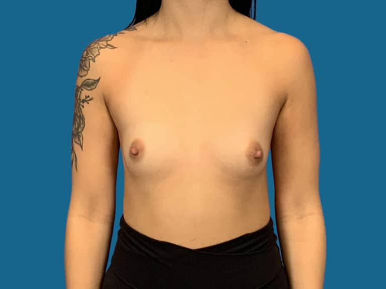 Before Image:  - front