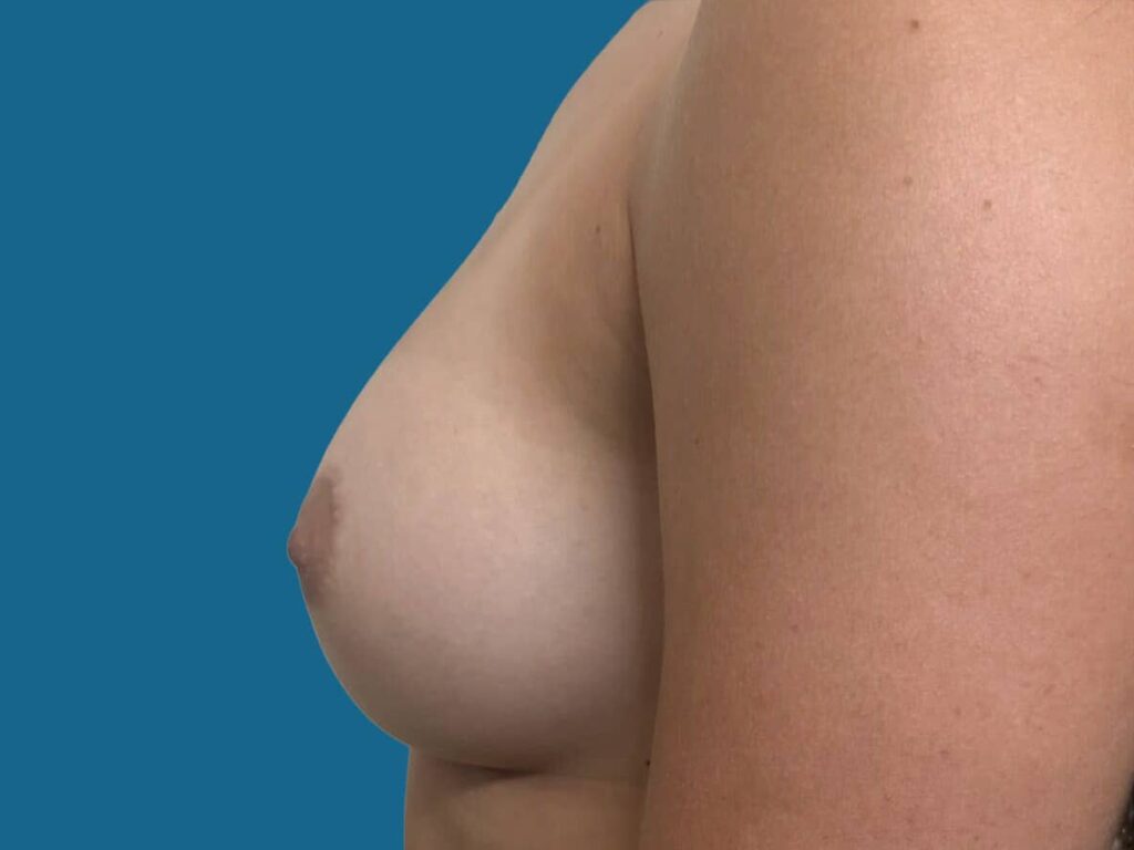 After Image:  - front