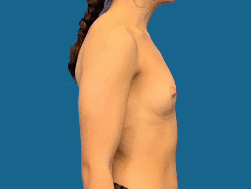 Before Image:  - right-side