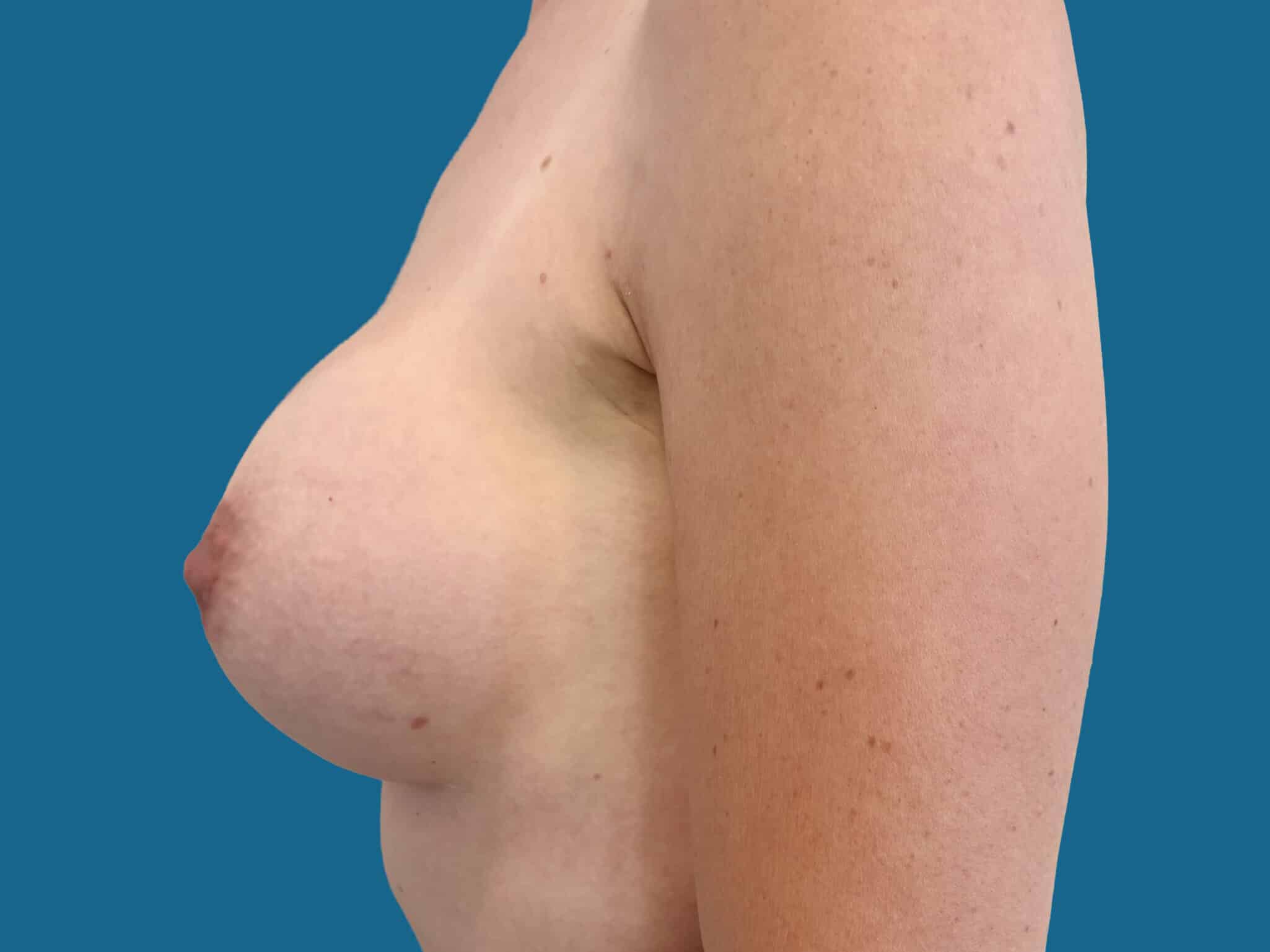 After Image:  - front