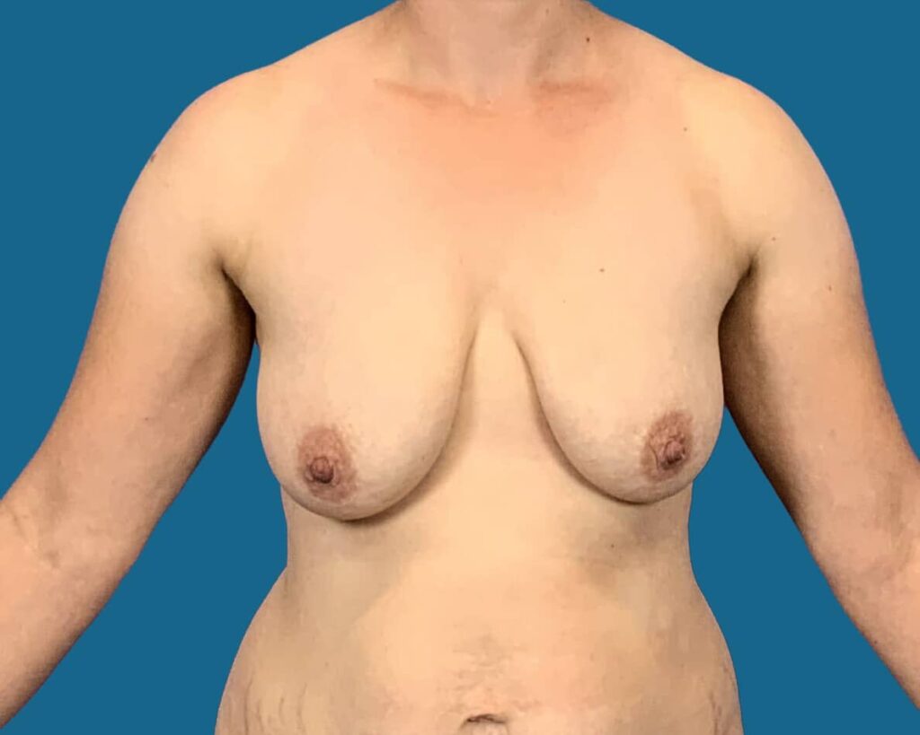 Before Image:  - front