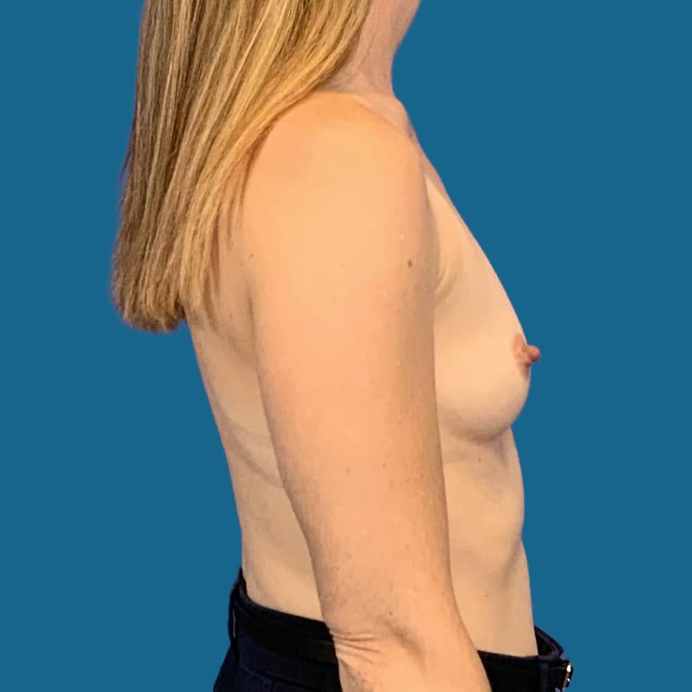 Before Image:  - front