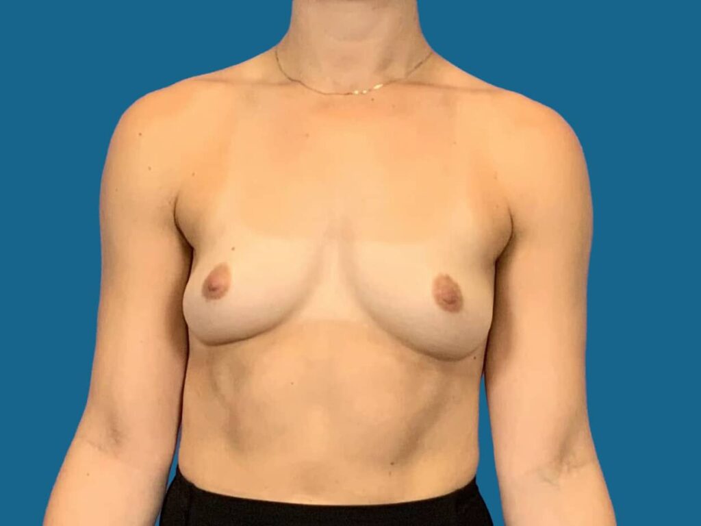 Before Image:  - front
