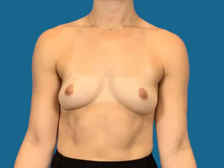 Before Image:  - front