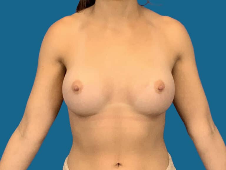 After Image:  - front