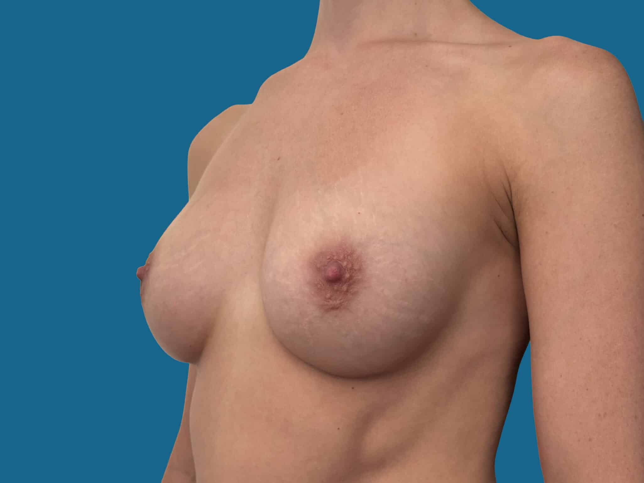 After Image:  - front