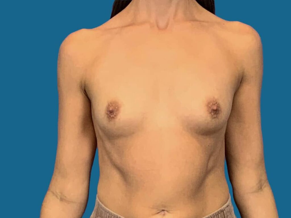 Before Image:  - front