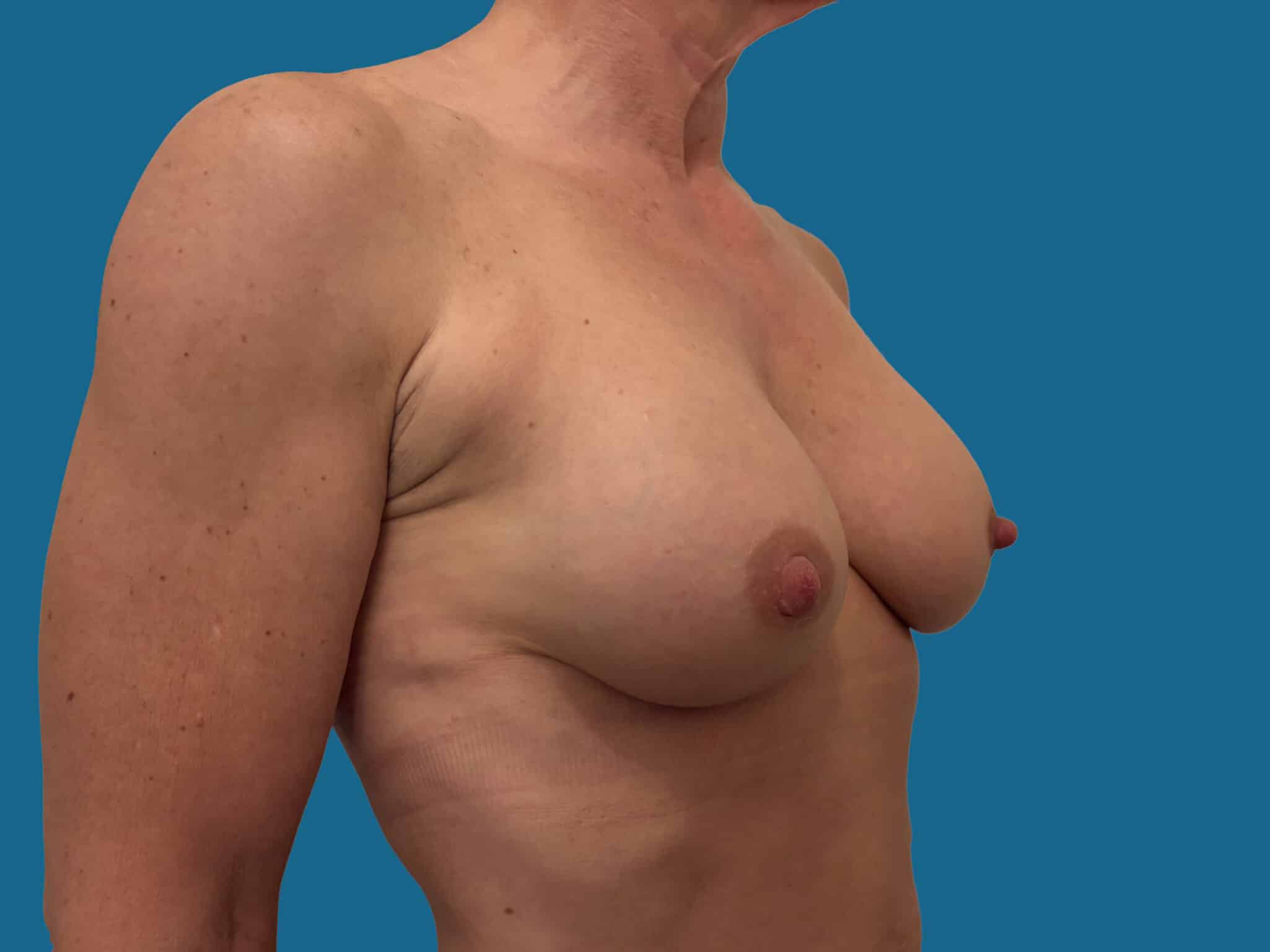 After Image:  - front