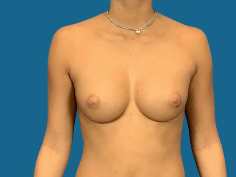 After Image:  - front