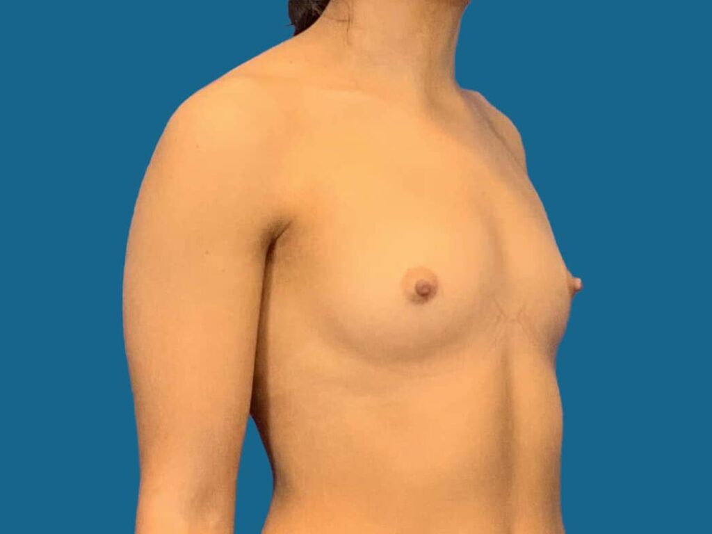 Before Image:  - right-front-oblique