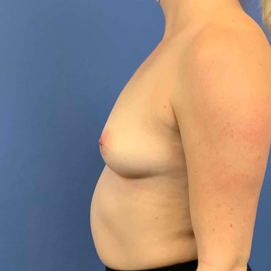 Before Image: Patient 43452 - left-side