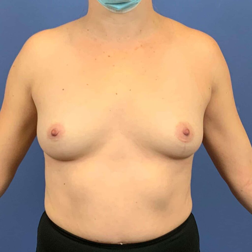 Before Image: Patient 43452 - front