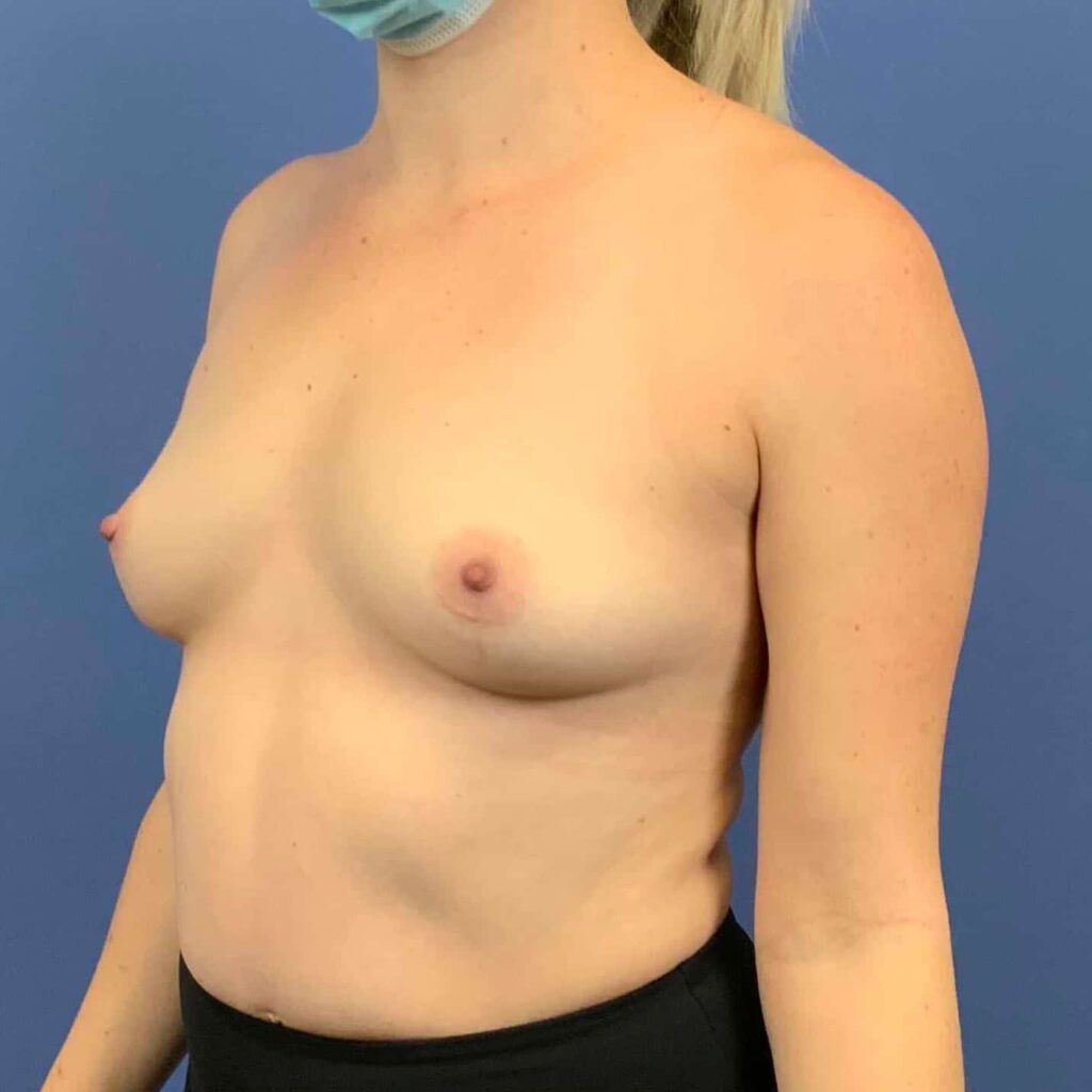 Before Image: Patient 43452 - left-front-oblique