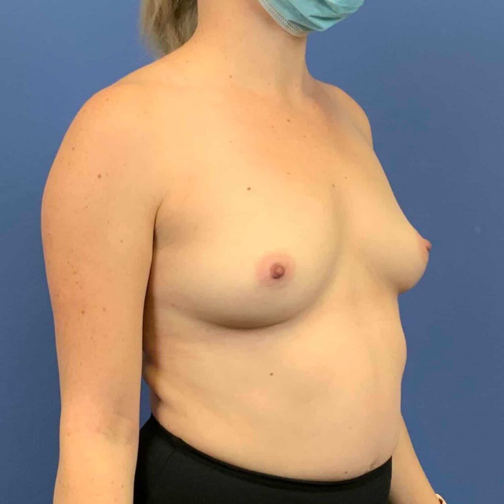 Before Image: Patient 43452 - right-front-oblique