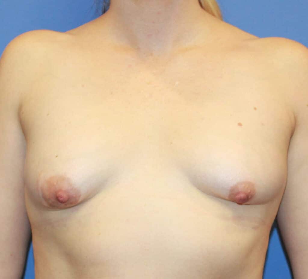 Before Image: Patient #11111 - front