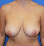 Before Image: Patient # 56093 - front