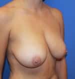 Before Image: Patient # 56093 - right-front-oblique
