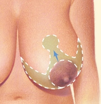 before Breast Reduction Salt Lake City UT