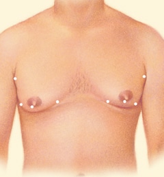 Male Breast Reduction Salt Lake City UT