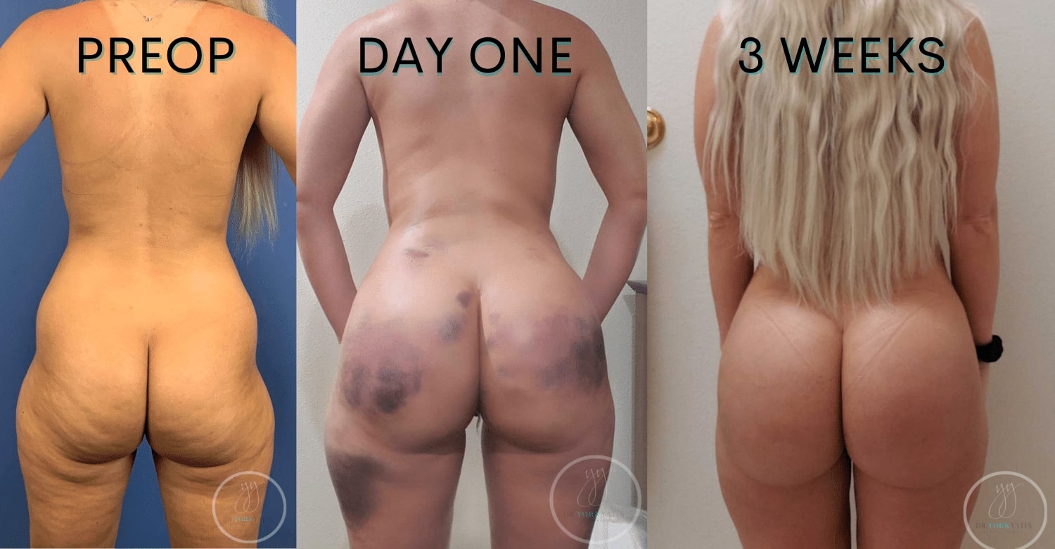 Brazilian Butt Lift Salt Lake City UT