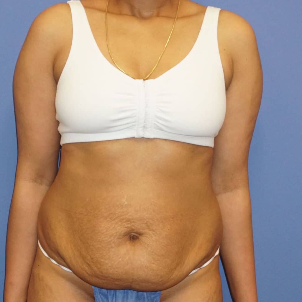 Before Image: Patient 43354 - front