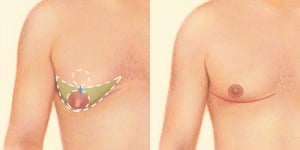 before and after Male Breast Reduction Utah