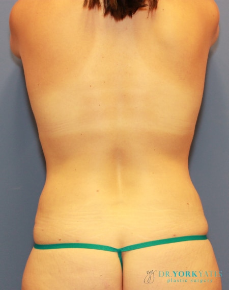 After Image: Patient # 34949 - back