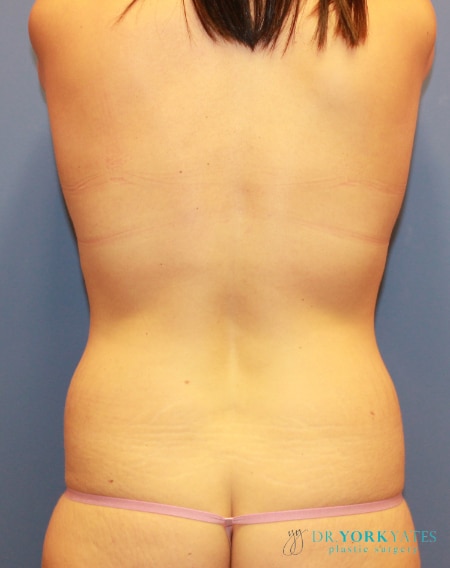 Before Image: Patient # 34949 - back