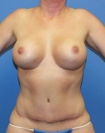 After Image: Patient # 94638 - front