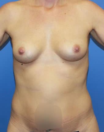 Before Image: Patient # 94638 - front