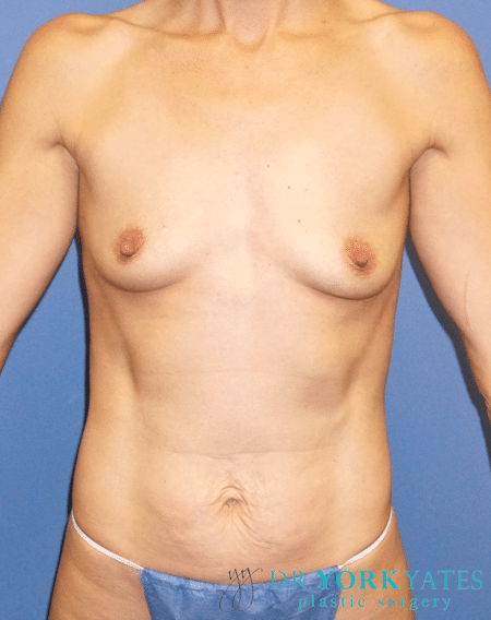 Before Image: Patient # 97321 - front