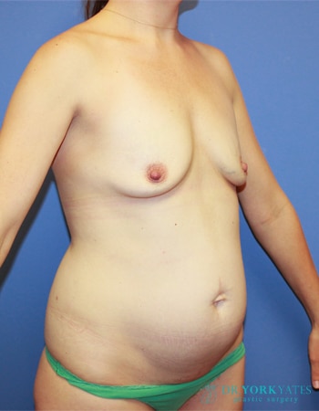 Before Image: Patient # 98787 - right-front-oblique