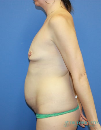 Before Image: Patient # 98787 - left-side