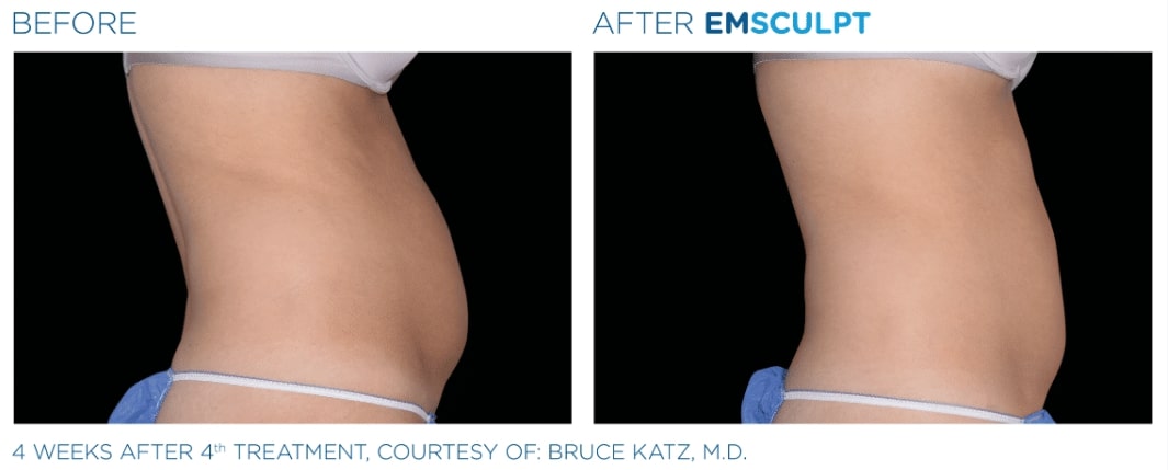 before and after Emsculpt treatment Utah