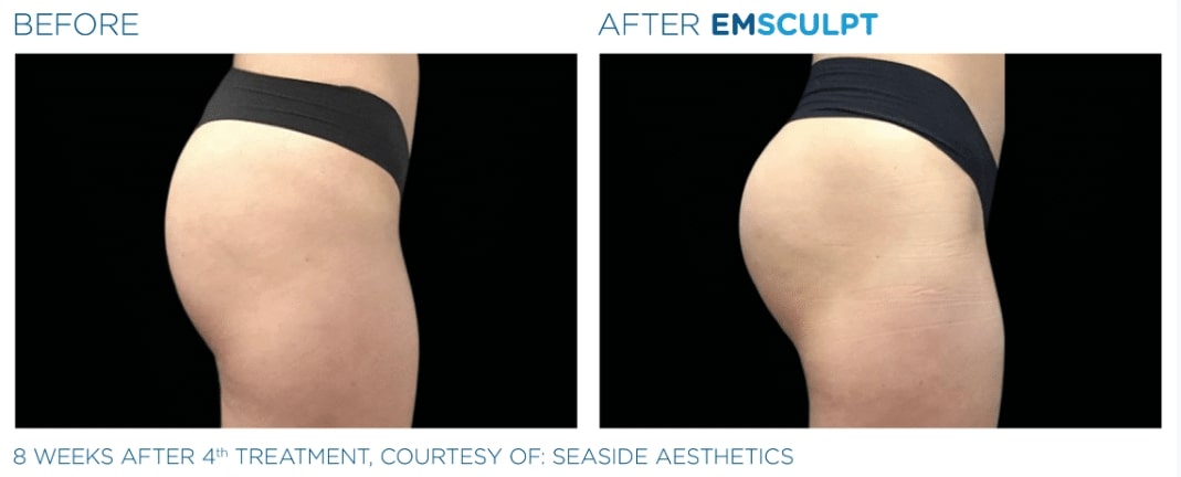 before and after Emsculpt treatment salt lake city Utah