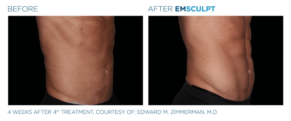 before and after Emsculpt treatment Salt Lake City