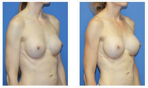 before and after Breast Implant Revision Salt Lake City UT