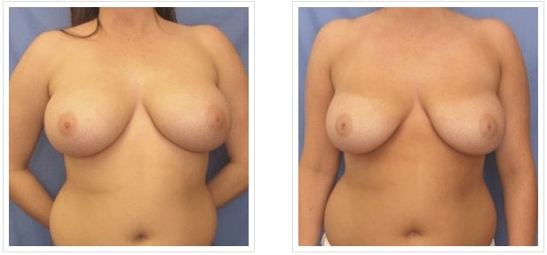 before and after Scarless Breast Reduction Salt Lake City UT
