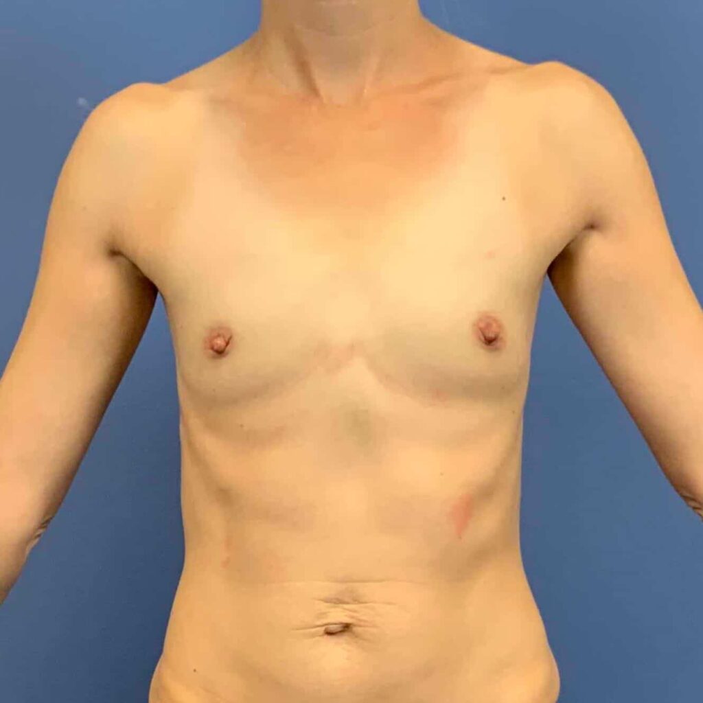 Before Image: PATIENT # 43322 - front