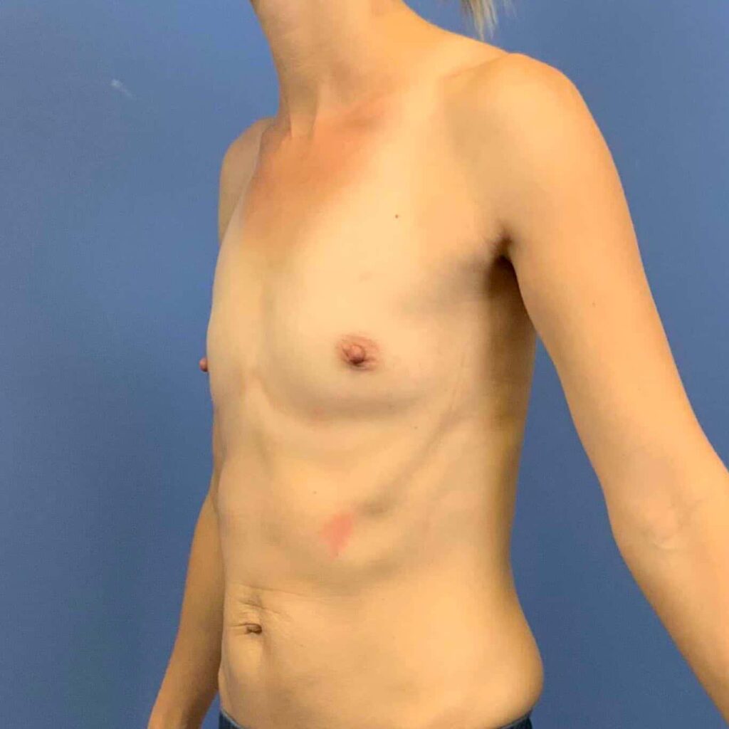 Before Image: PATIENT # 43322 - left-front-oblique