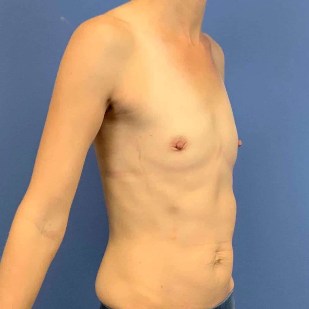 Before Image: PATIENT # 43322 - right-front-oblique