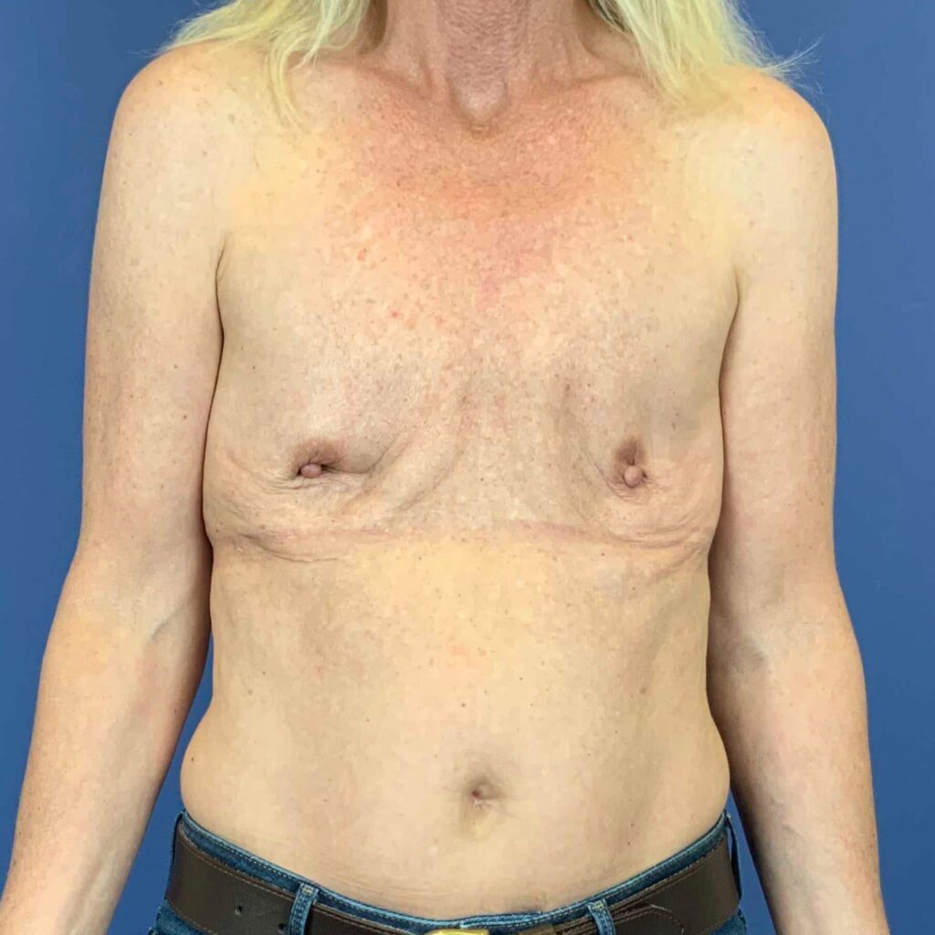 Before Image: Patient 43358 - front
