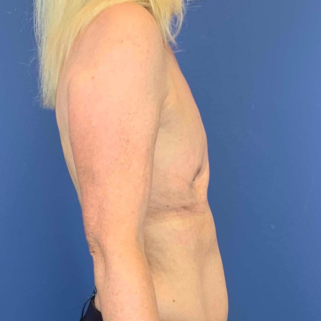 Before Image: Patient 43358 - right-side