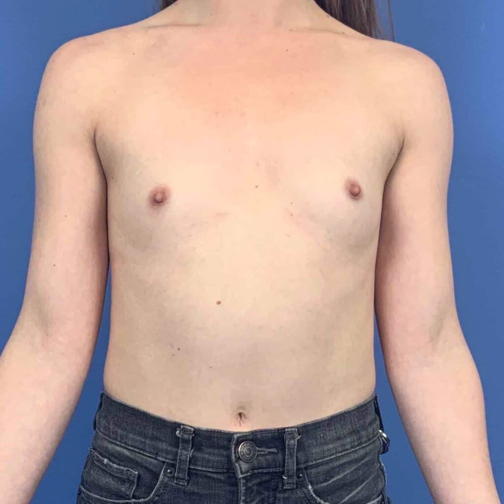 Before Image: Patient 43412 - right-front-oblique