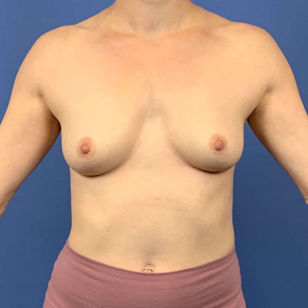 Before Image: Patient 43445 - front