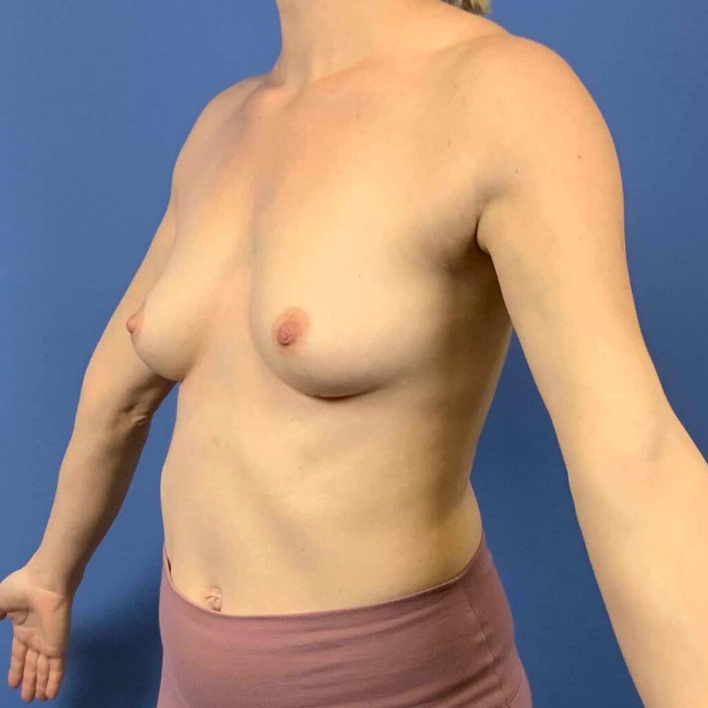 Before Image: Patient 43445 - left-front-oblique