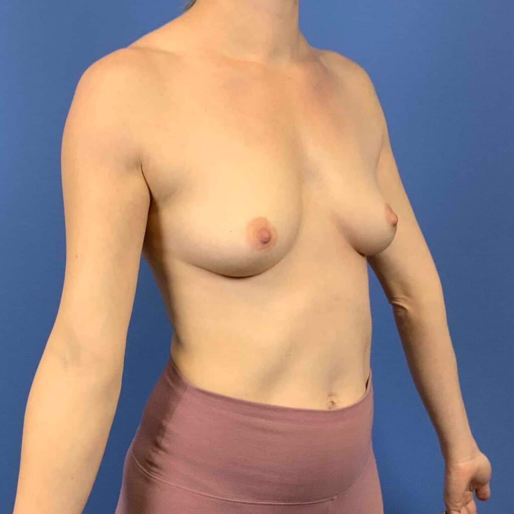Before Image: Patient 43445 - right-front-oblique