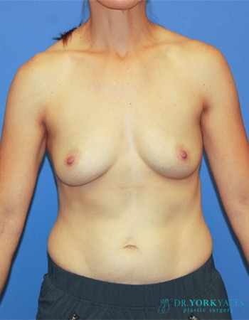Before Image: Patient # 82728 - front